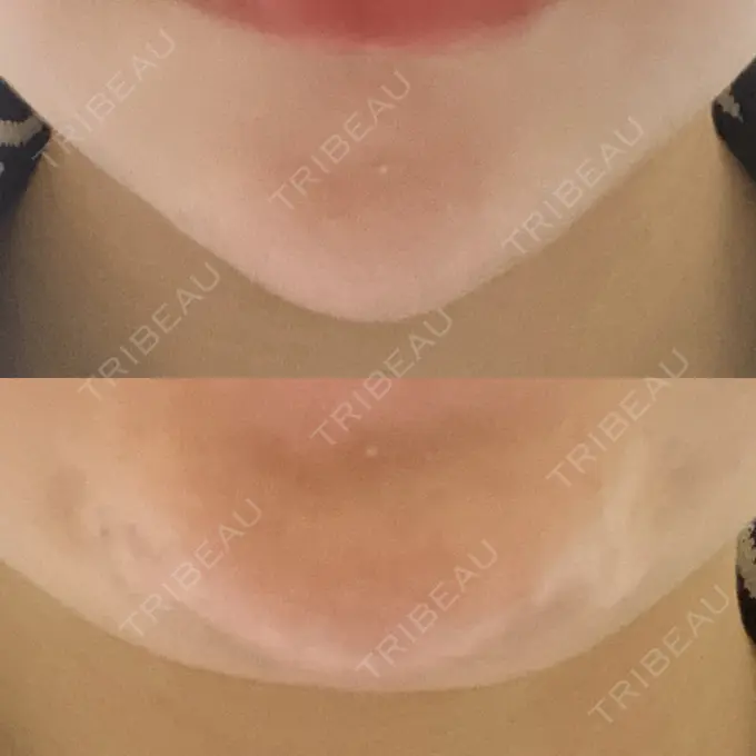 ボトックス（あご） 湘南美容クリニック 金山院 DAY 5 メイン用