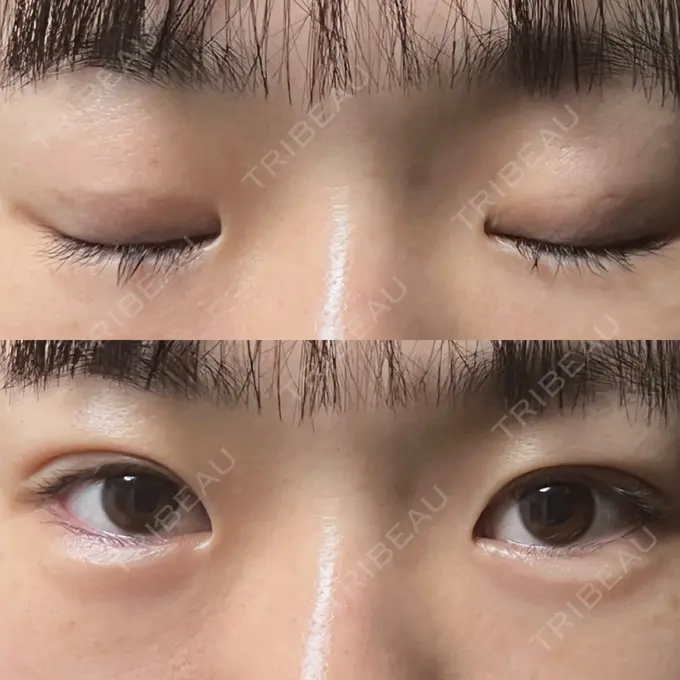 二重埋没 / ヒアルロン酸注入（涙袋） 藤・ナチュレ美容クリニック 銀座院 AFTER メイン用