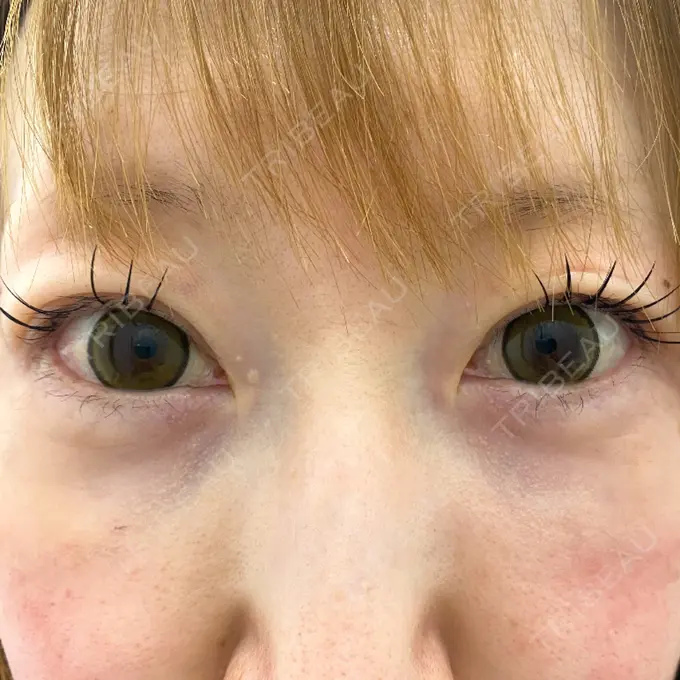 シワ取りボトックス / スネコス TCB東京中央美容外科 宇都宮院 DAY 15 メイン用