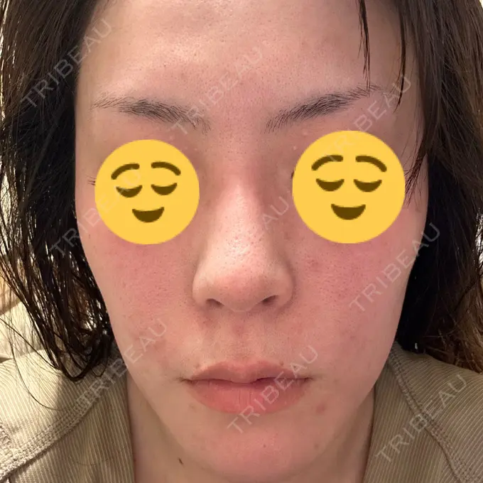 ダーマペン ライズワン美容皮膚科クリニック DAY 9 メイン用