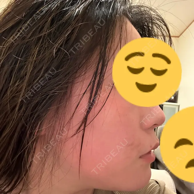 ダーマペン ライズワン美容皮膚科クリニック DAY 9 メイン用