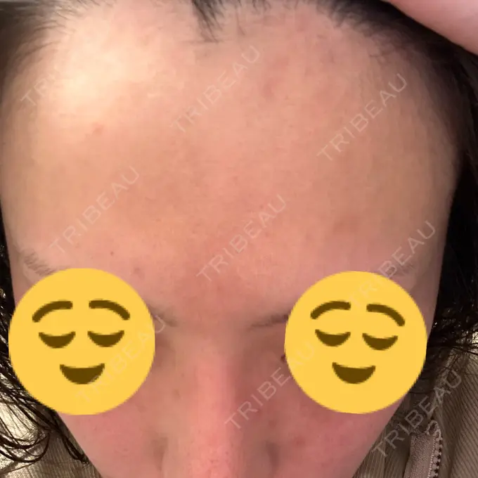 ダーマペン ライズワン美容皮膚科クリニック DAY 9 メイン用