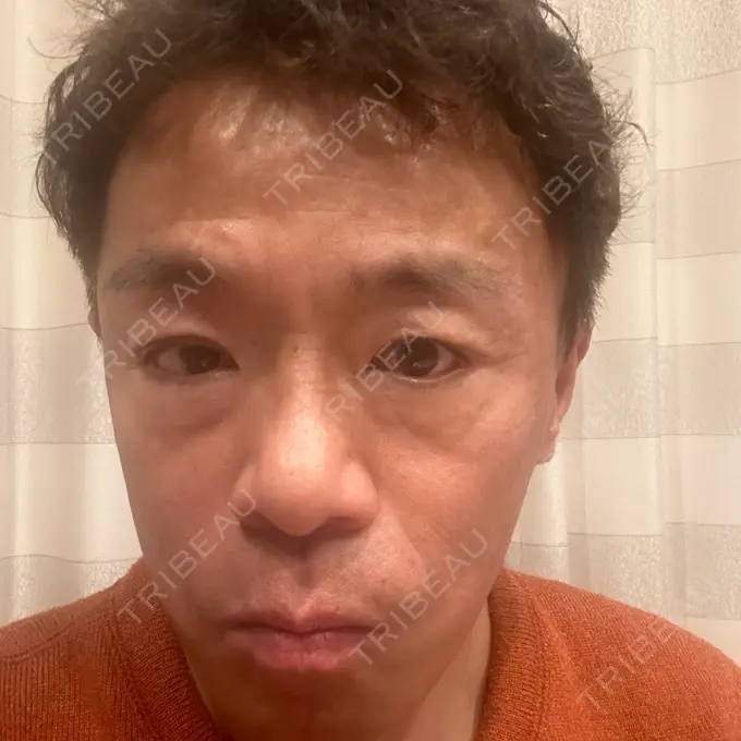 肌ヒアルロン酸注入（たるみ・シワ改善） / シワ取りボトックス / ボトックス（眉間） TCB東京中央美容外科 長野院 AFTER メイン用