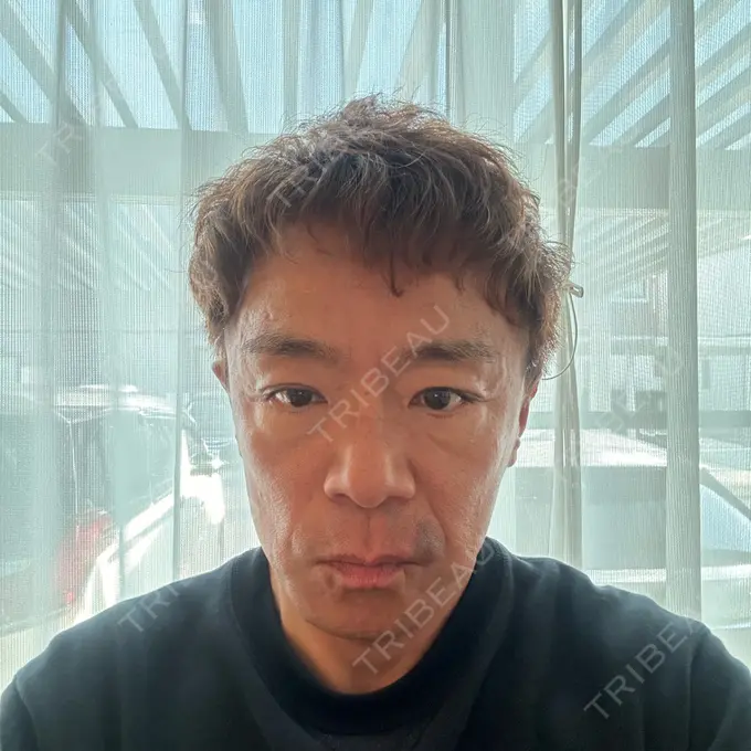 肌ヒアルロン酸注入（たるみ・シワ改善） / シワ取りボトックス / ボトックス（眉間） TCB東京中央美容外科 長野院 DAY 15 メイン用