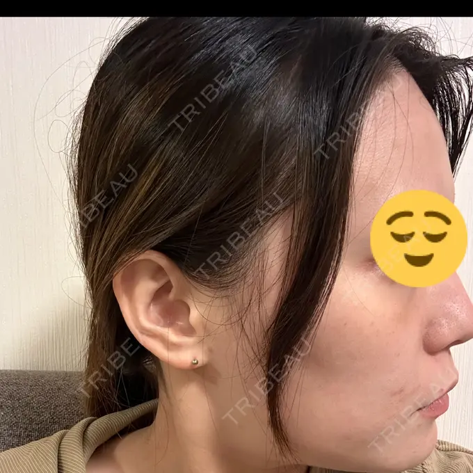 ダーマペン ライズワン美容皮膚科クリニック DAY 10 メイン用