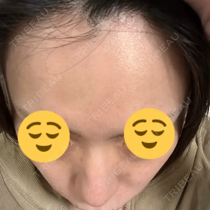 ダーマペン ライズワン美容皮膚科クリニック DAY 10 メイン用