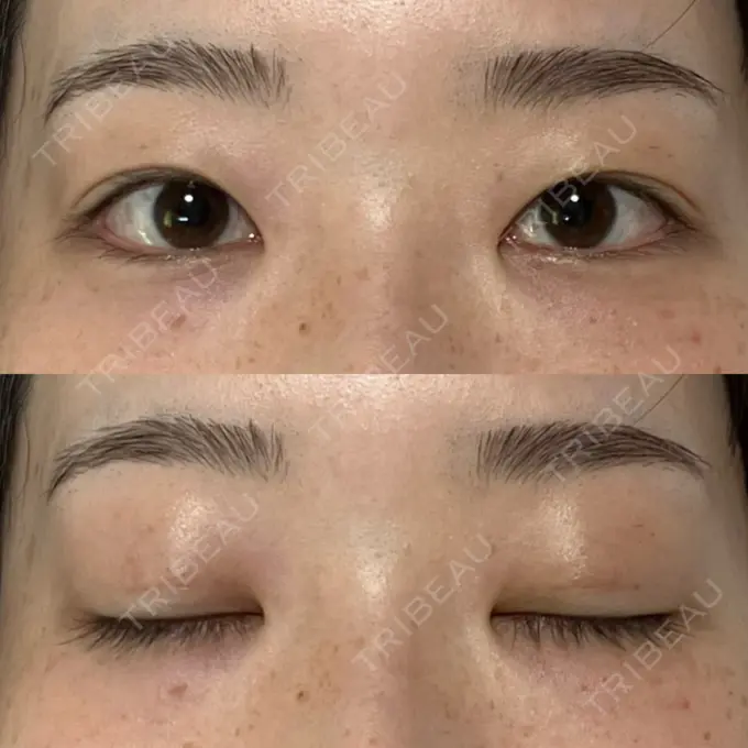 二重埋没 水の森美容クリニック 名古屋院 AFTER メイン用