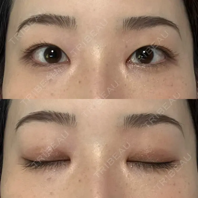 二重埋没 水の森美容クリニック 名古屋院 DAY 14 メイン用