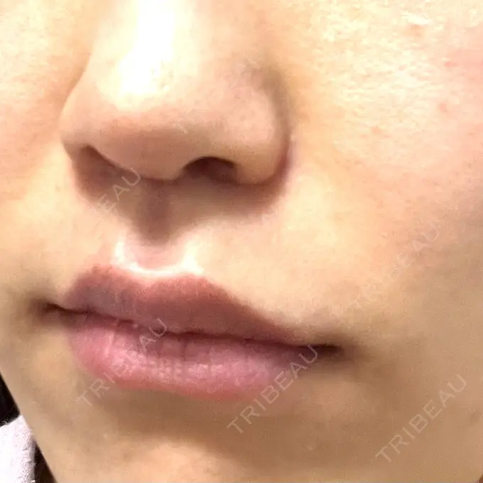 小鼻縮小（切開） / 人中短縮 Otus Clinic 【オータスクリニック】 AFTER メイン用