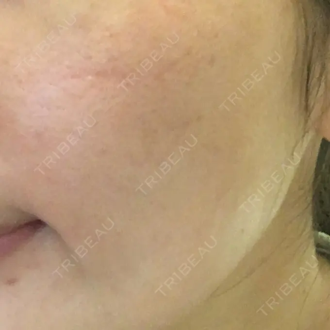 水光注射（ハリ・美肌） / 脂肪溶解注射（顔） / ハイフ（顔） チョンダムジュエンクリニック DAY 16 メイン用