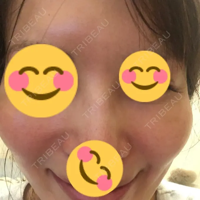 水光注射（ハリ・美肌） / 脂肪溶解注射（顔） / ハイフ（顔） チョンダムジュエンクリニック DAY 16 メイン用