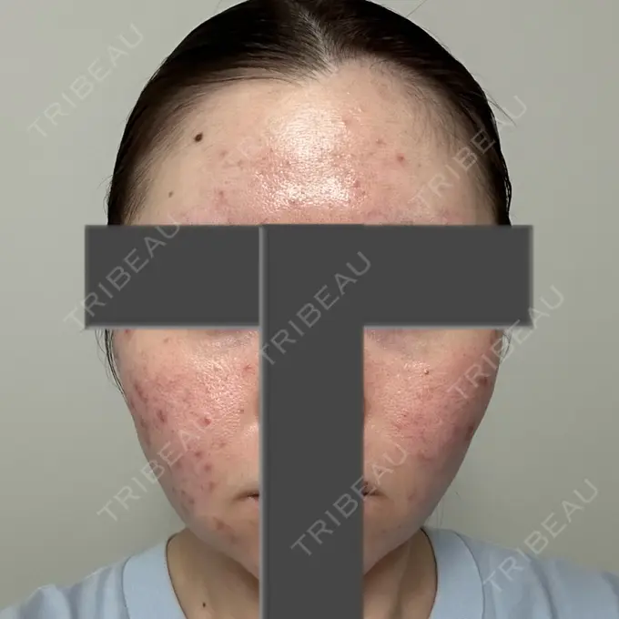 ニードルRF（ポテンツァなど） 東京美容外科 池袋院 AFTER メイン用