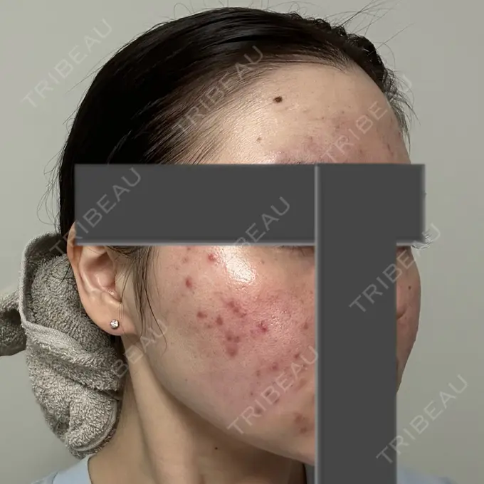 ニードルRF（ポテンツァなど） 東京美容外科 池袋院 DAY 7 メイン用