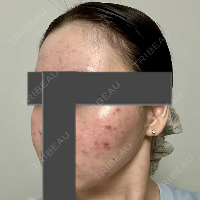 ニードルRF（ポテンツァなど） 東京美容外科 池袋院 DAY 7 メイン用