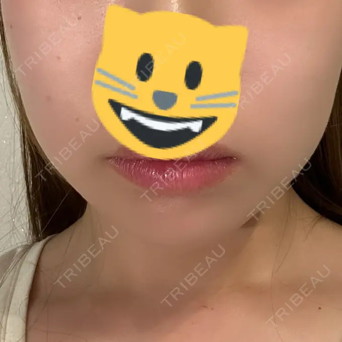 ヒアルロン酸注入（あご） / 脂肪溶解注射（顔） 麻布十番クレールデンタルクリニック AFTER メイン用