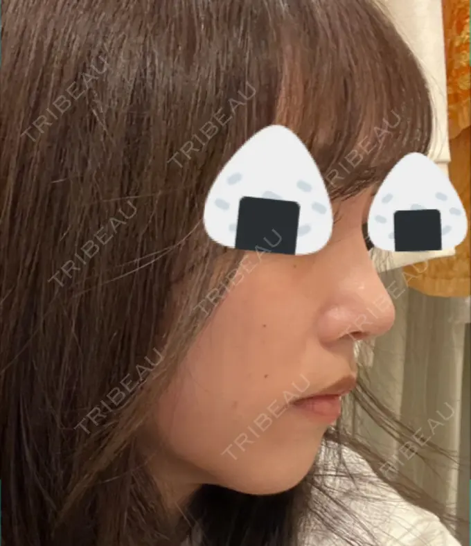 鼻尖形成（切開） / 軟骨移植 / 鼻尖縮小 / GLP-1ダイエット 東京シンデレラ美容外科 新宿院 DAY 9 メイン用