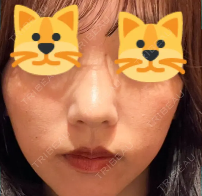 鼻尖形成（切開） / 軟骨移植 / 鼻尖縮小 / GLP-1ダイエット 東京シンデレラ美容外科 新宿院 DAY 10 メイン用