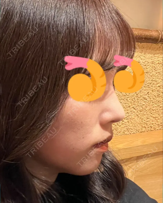 鼻尖形成（切開） / 軟骨移植 / 鼻尖縮小 / GLP-1ダイエット 東京シンデレラ美容外科 新宿院 DAY 10 メイン用