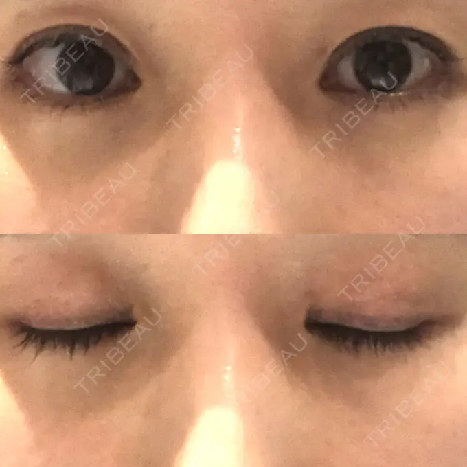 二重埋没 水の森美容クリニック 名古屋院 DAY 5 メイン用