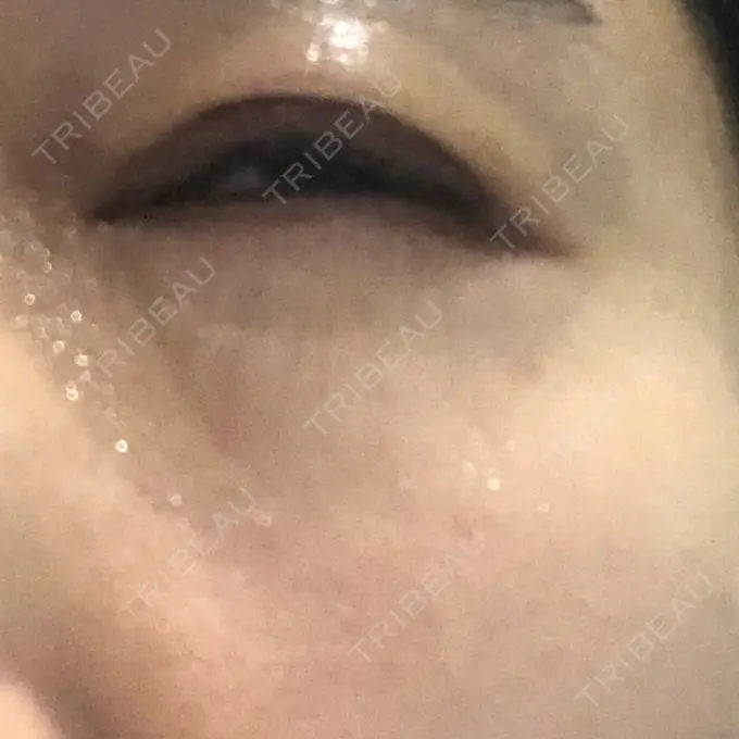 二重埋没 水の森美容クリニック 名古屋院 DAY 5 メイン用