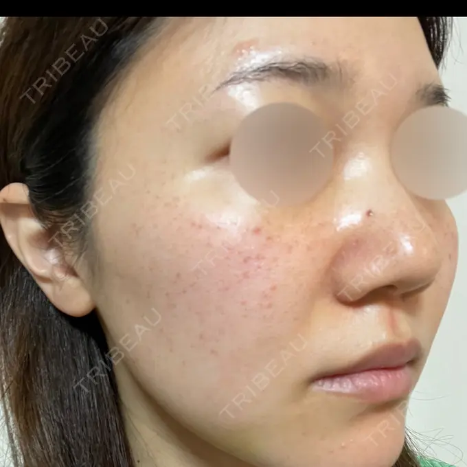 ピーリング（ニキビ・毛穴） / ルメッカ ルラ美容クリニック 名古屋本院 DAY 0 メイン用