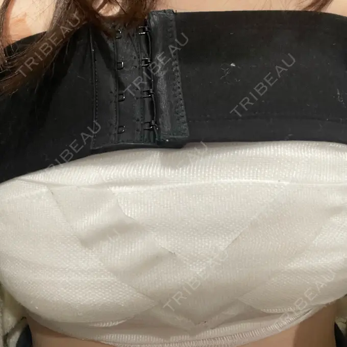 豊胸（シリコンバッグ） MYCLI【マイクリ】東京・恵比寿院 DAY 1 メイン用