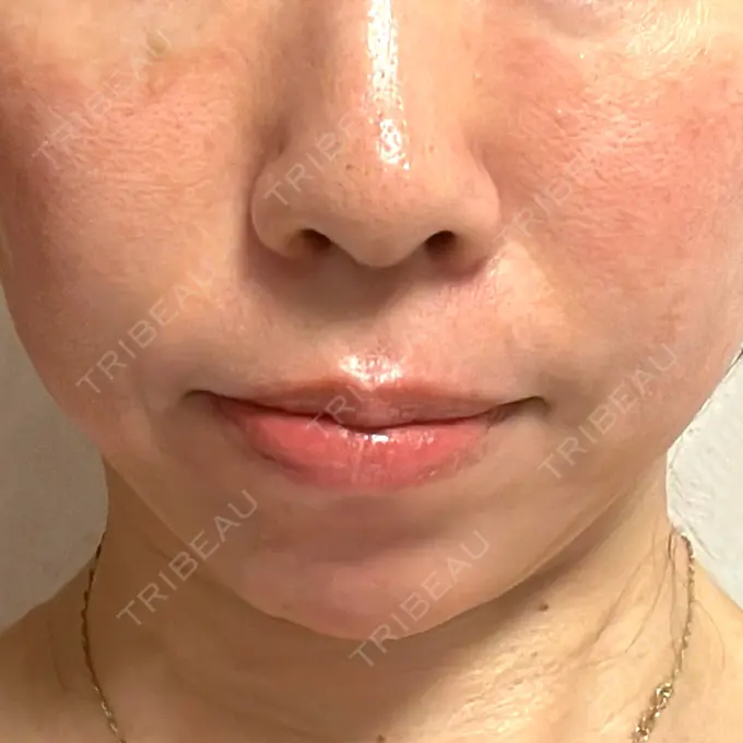 ピコレーザートーニング（美白・肝斑） / ピコフラクショナルレーザー（毛穴・ニキビ跡） G MEDICAL ART クリニック 新宿院 AFTER メイン用