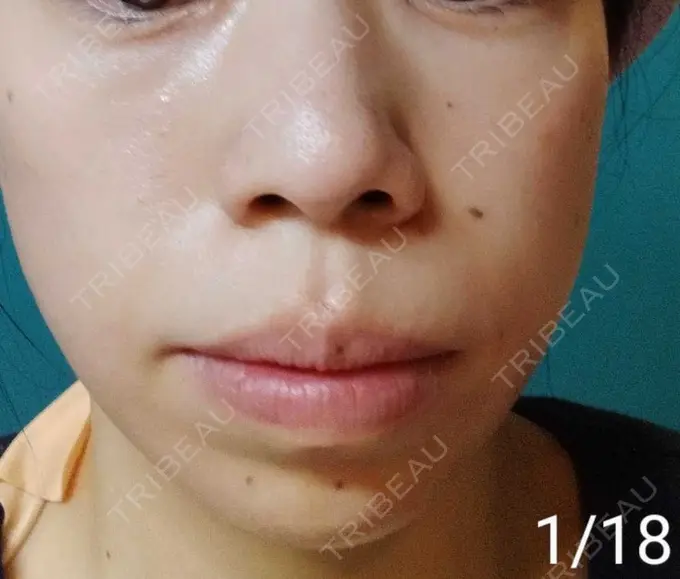 光治療（フォトフェイシャルなど） Wi Clinic（ウィ クリニック） 大宮院 DAY 13 メイン用