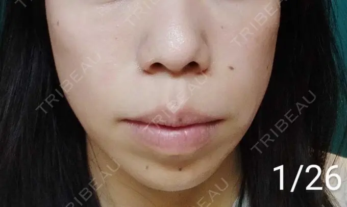 光治療（フォトフェイシャルなど） Wi Clinic（ウィ クリニック） 大宮院 AFTER メイン用