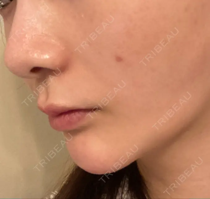 ヒアルロン酸注入（鼻翼基部） バログ医院 江南院 DAY 43 メイン用