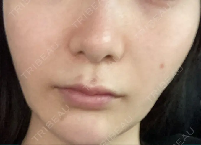 ヒアルロン酸注入（鼻翼基部） バログ医院 江南院 DAY 39 メイン用