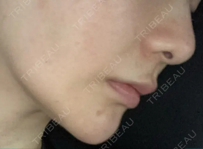 ヒアルロン酸注入（鼻翼基部） バログ医院 江南院 DAY 39 メイン用