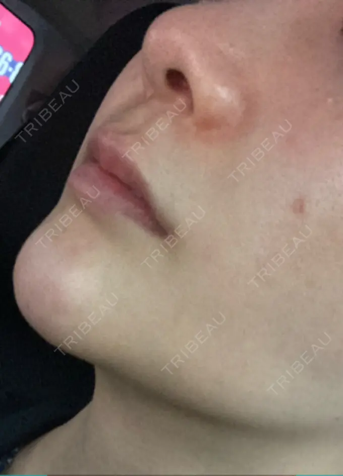 ヒアルロン酸注入（鼻翼基部） バログ医院 江南院 DAY 39 メイン用