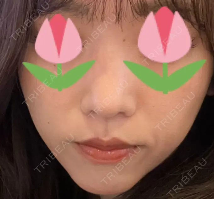 鼻尖形成（切開） / 軟骨移植 / 鼻尖縮小 / GLP-1ダイエット 東京シンデレラ美容外科 新宿院 DAY 13 メイン用