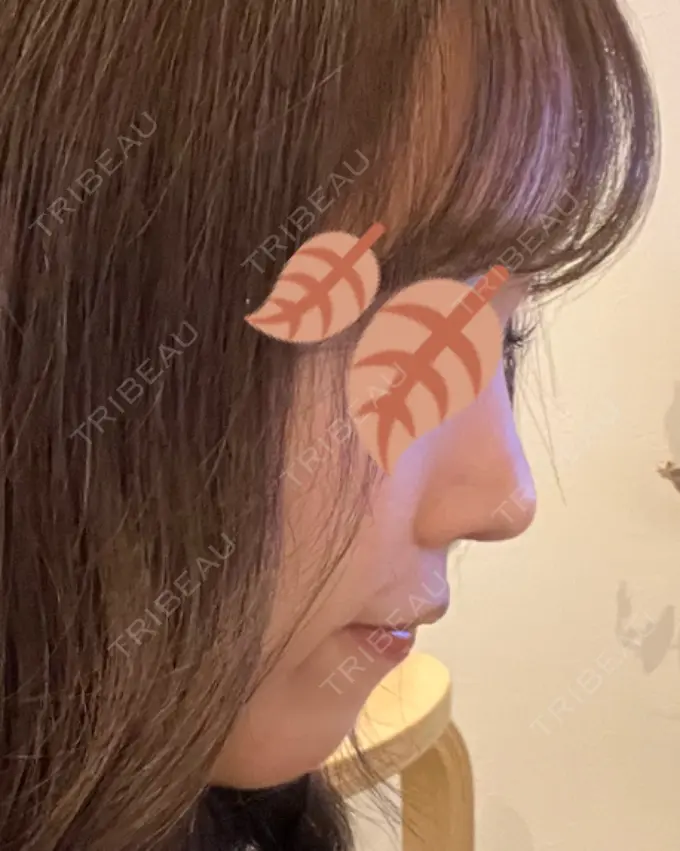 鼻尖形成（切開） / 軟骨移植 / 鼻尖縮小 / GLP-1ダイエット 東京シンデレラ美容外科 新宿院 DAY 13 メイン用