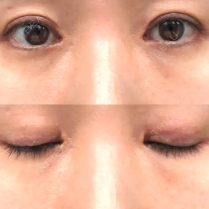 二重埋没 水の森美容クリニック 名古屋院 DAY 7 メイン用