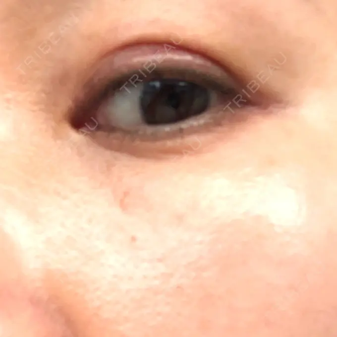 二重埋没 水の森美容クリニック 名古屋院 DAY 7 メイン用