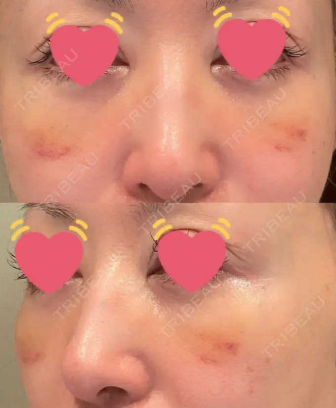 クマ治療 / 下まぶたたるみ取り / 脂肪注入（目の下） / ヒアルロン酸溶解 X CLINIC 大阪院 DAY 16 メイン用