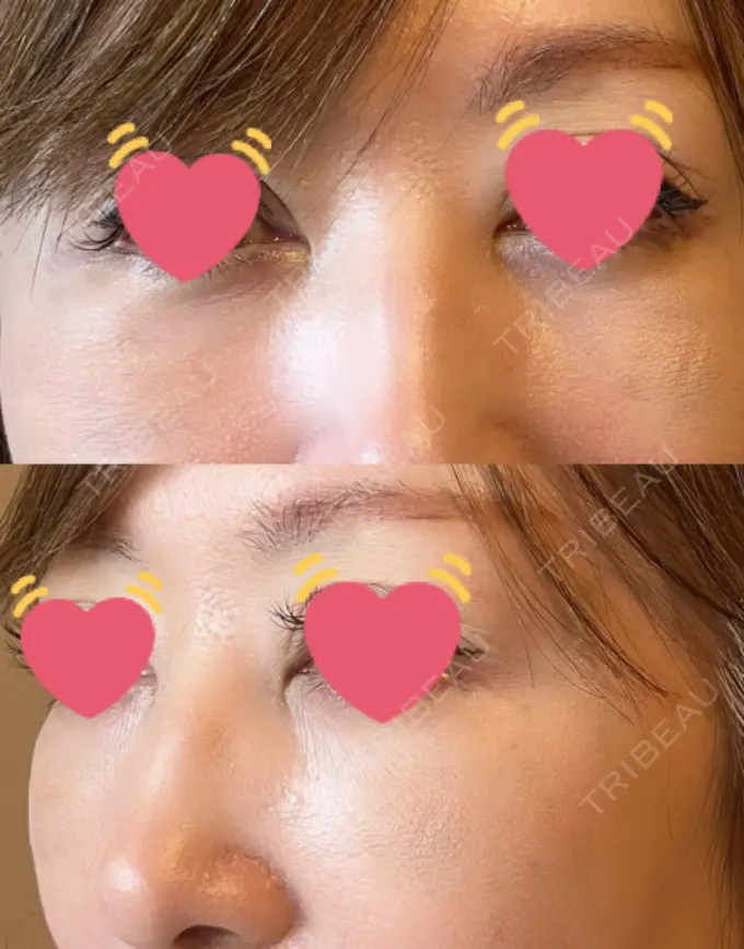 クマ治療 / 下まぶたたるみ取り / 脂肪注入（目の下） / ヒアルロン酸溶解 X CLINIC 大阪院 DAY 16 メイン用