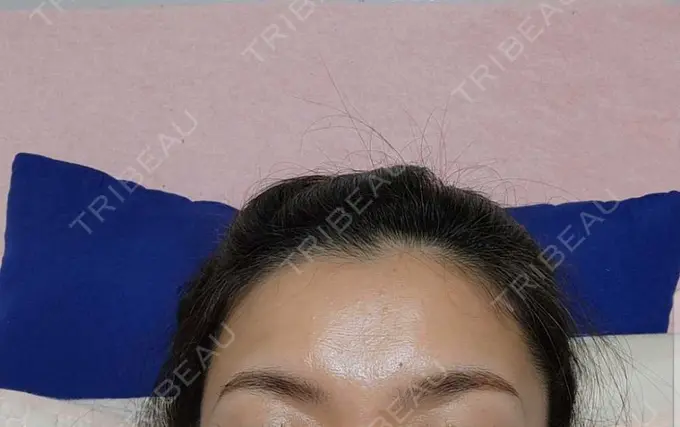 脂肪溶解注射（顔） / ボトックス（目尻） / ボトックス（額） TCB東京中央美容外科 名古屋栄院 DAY 0 メイン用