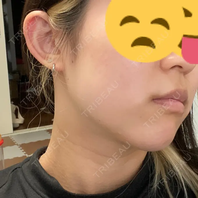 ボトックス（エラ・小顔） ルラ美容クリニック 上野院 DAY 28 メイン用