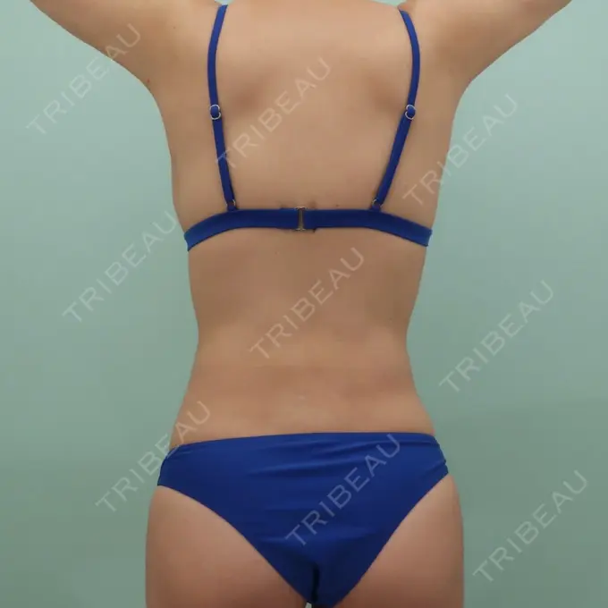 脂肪吸引（お腹） / 脂肪吸引（背中） WOM CLINIC GINZA （ワム クリニック ギンザ） DAY 95 メイン用