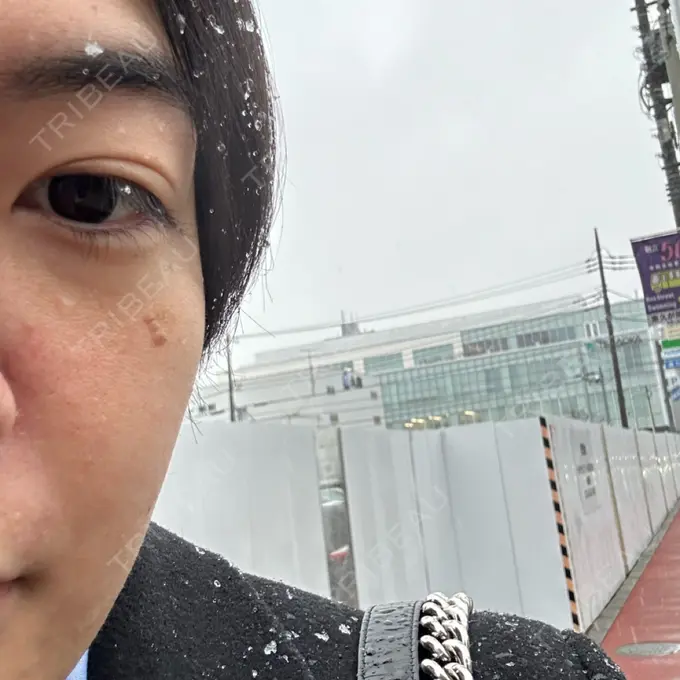 ほくろ・いぼ除去レーザー（肌） Mavie Beauty Clinic （マヴィービューティークリニック） AFTER メイン用