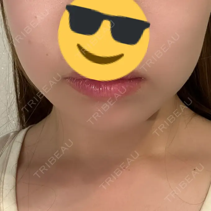 ボトックス（エラ・小顔） CLINIC W DAY 13 メイン用