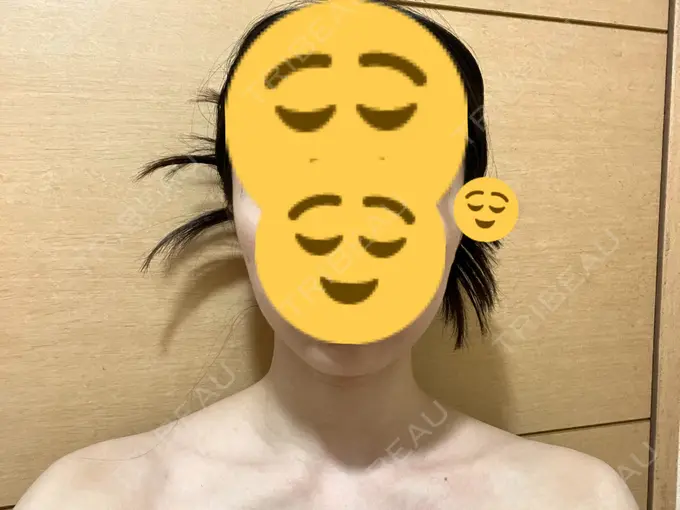 ボトックス（エラ・小顔） / ボトックス（肩） THE FIRST CLINIC 多摩センター院 DAY 23 メイン用