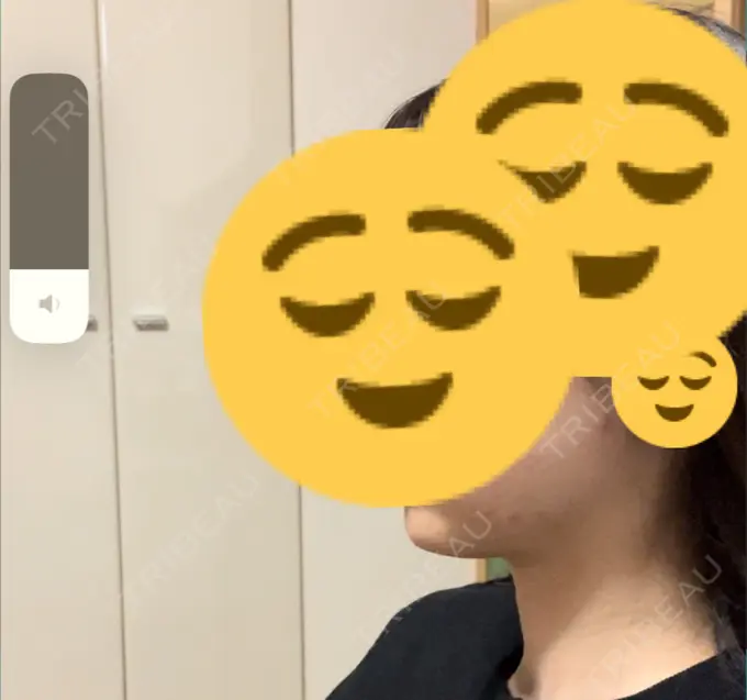 ボトックス（エラ・小顔） / ボトックス（肩） THE FIRST CLINIC 多摩センター院 DAY 23 メイン用