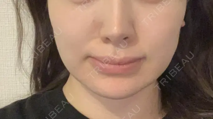 脂肪吸引（顔） / ボトックス（あご） / ヒアルロン酸注入（唇） / ヒアルロン酸溶解 藤・ナチュレ美容クリニック 恵比寿院 DAY 27 メイン用