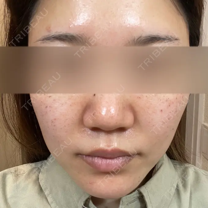 ピーリング（ニキビ・毛穴） / ルメッカ ルラ美容クリニック 名古屋本院 DAY 1 メイン用