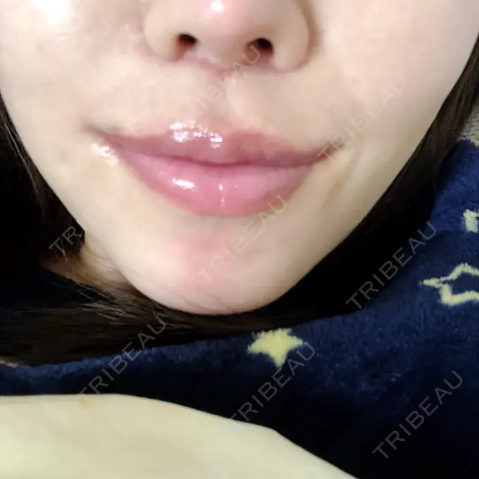 人中短縮 / 口唇縮小術 / 口角挙上 HB整形外科 DAY 23 メイン用