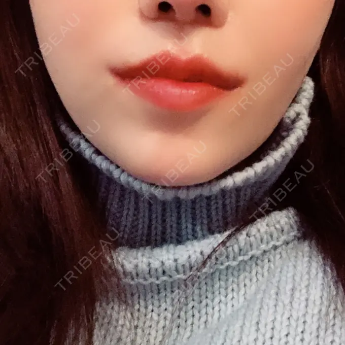 人中短縮 / 口唇縮小術 / 口角挙上 HB整形外科 DAY 23 メイン用